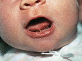 tongue tie frenectomy patient