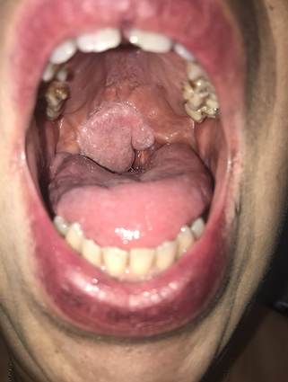 lambeau antebrachial reconstruction voil