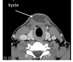 KTT: kyste du tractus thyreoglosse. Images scanner