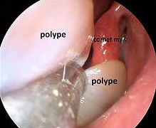 Aspect endoscopique d'un polype antro choanal de Killian