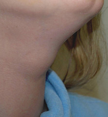 KTT: kyste du tractus thyreoglosse. Aspect clinique
