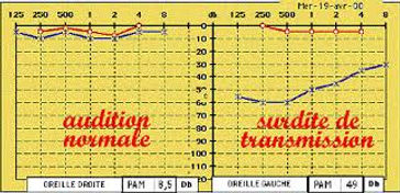Audiogramme: audition normale et surdité de transmission
