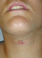 KTT: kyste du tractus thyreoglosse. Aspect clinique d'une fistule