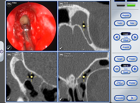 Chirurgie sinus avec navigation assistée par ordinateur