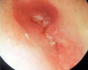 otite externe sur sténose CAE: aspect otoscopique