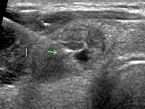 Nodule thyroïde: ponction échoguidée