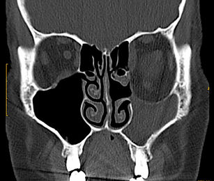 Silent Sinus Syndrom: TDM coupe fronale