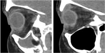 Silent sinus syndrom: aspect TDM