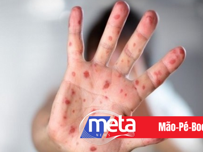 Saúde Infantil – Surto de Mão- Pé – Boca ocasiona 161 casos, na capital