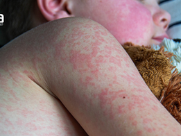 Saúde – Vacinação para o Sarampo se intensifica, com retorno de casos da doença no mundo