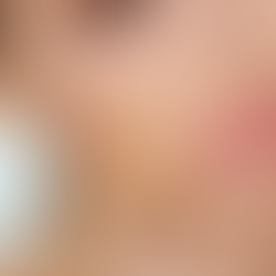 Let's talk lip filler and dissolving...⠀