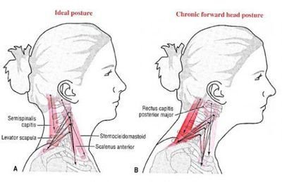 Graphic showing healthy neck posture and forward head posture