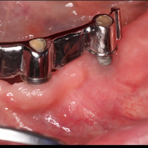 Az implantátum körüli lágyrész szerepe – több mint esztétika