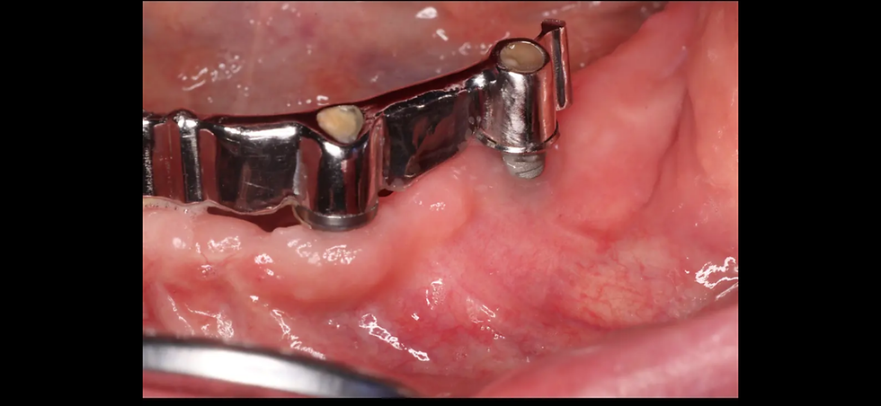 Az implantátum körüli lágyrész szerepe – több mint esztétika