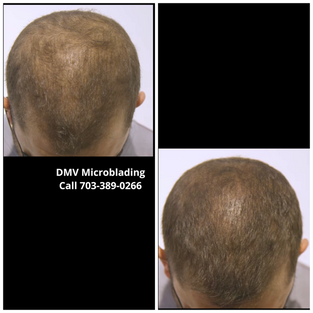 Hairline Pigmentation 6.png