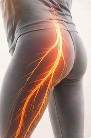 Sciatica
