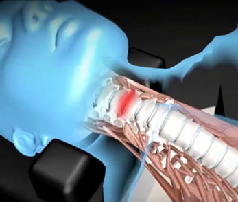 Spinal disc compression