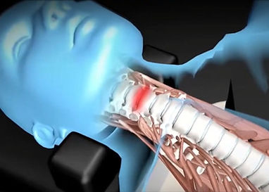 Spinal disc compression