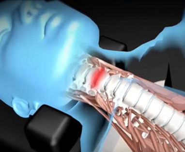 Spinal disc compression