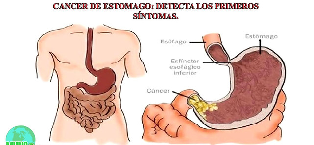 Cáncer de Estómago, Doctor Luis Javier Cárdenas