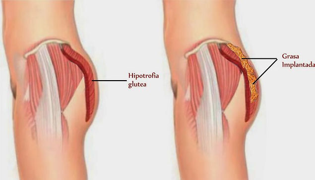 gluteos-con-grasa-768x440.jpg
