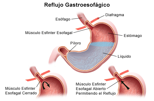 Obesidad con Reflujo