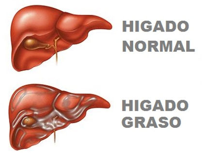 Hígado Graso | Patología del Hígado | Doctor Lus Javier Cárdenas