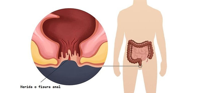 Una fisura anal es un pequeño desgarro en el tejido delgado y húmedo (mucosa) que recubre el ano