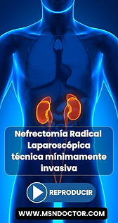 Nefrectomía Radical Laparoscópica