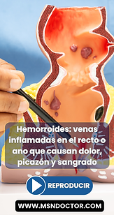 Hemorroides, síntomas y solución