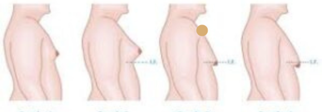 La ginecomastia es el aumento benigno del tejido mamario en hombres, que puede presentarse en una o ambas mamas.