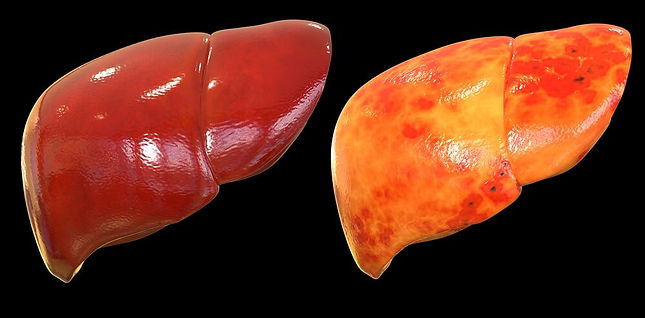 Hígado Graso | Patología del Hígado | Doctor Lus Javier Cárdenas