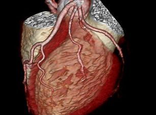 CT-Coronary-Angiogram_JC_Picts.jpg