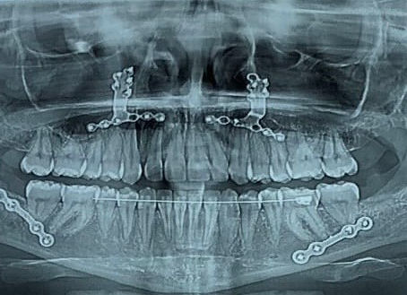 Cirugía ortognática: cómo puede ayudarte la fisioterapia antes y después de la operación