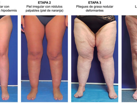 Lipedama logroño drenaje linfático