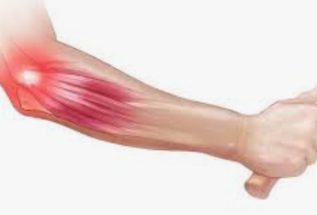 ¿TIENE SOLUCION LA TENDINITIS?