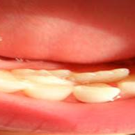 Retained baby teeth