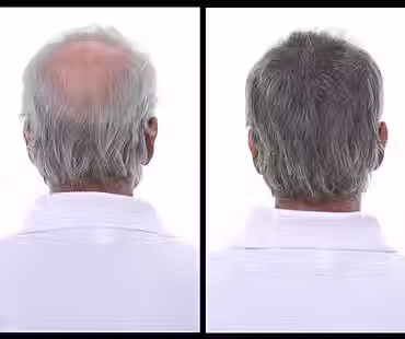 High-Quality Hair Patch in Bangalore – Flair Hair Fixing