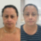 Transformação Toxina Botulínica: Prevenção e Rejuvenescimento 1