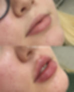 Resultado Preenchimento Facial, Harmonização e Gerenciamento do Envelhecimento 2