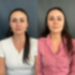 Resultado Preenchimento Facial, Harmonização e Gerenciamento do Envelhecimento 2