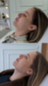 Resultado Preenchimento Facial, Harmonização e Gerenciamento do Envelhecimento 3