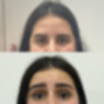 Transformação Toxina Botulínica: Prevenção e Rejuvenescimento 2