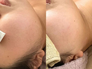お顔脱毛