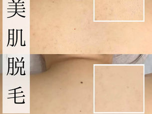 脱毛しながら美肌になれる