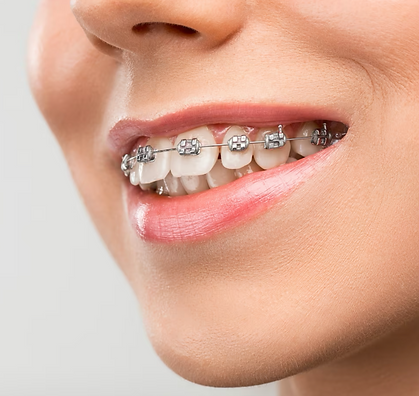 Braces.png