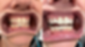 teeth whitening.png