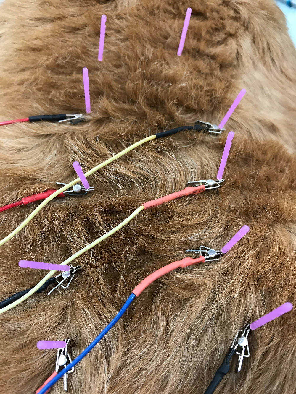 Electroacupuncture
