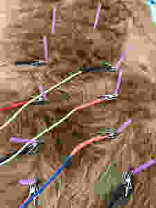 Electroacupuncture