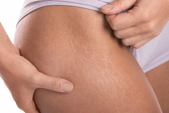 Formation dermopigmentation des cicatrices et de vergetures